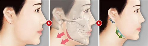 韩国gng与cbk整形医院下颌角特色与案例解析