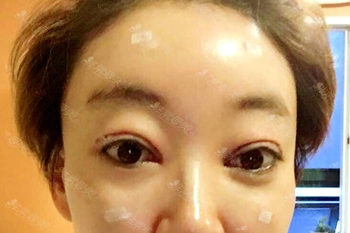 韩国清潭第一整形外科代表院长成镇模双眼皮修复术后第1天拆掉纱布后