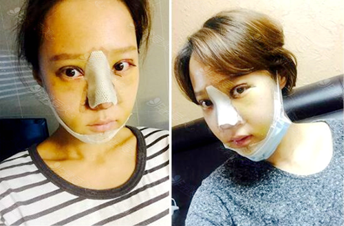 韩国灰姑娘整形医院网红脸打造术后第5天