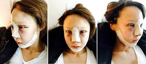 韩国灰姑娘整形医院网红脸打造术后第2天