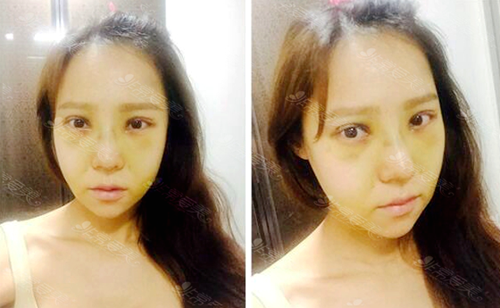 韩国灰姑娘整形医院网红脸打造术后第7天
