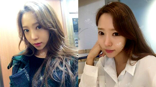 韩国灰姑娘整形医院网红脸打造术后6个月
