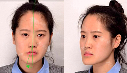 韩国爱宝整形医院颜面不对称+反颌矫正手术前的叶恩