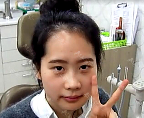 韩国爱宝整形医院双鄂手术后一见镜头就摆出V造型的叶恩