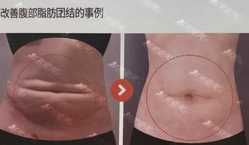 韩国365MC医院吸脂减肥腹部吸脂效果