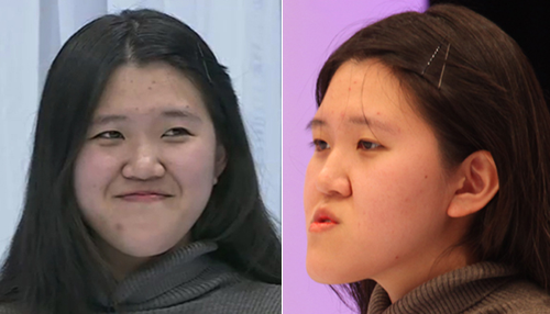 韩国正颌手术恢复过程日记多图记录变化