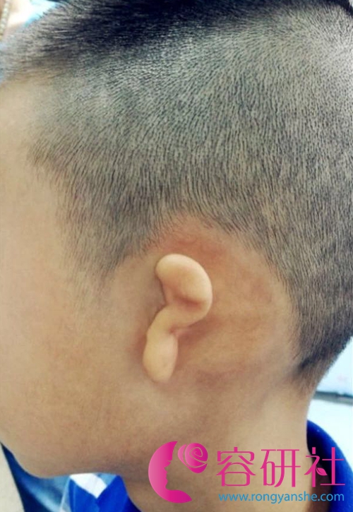 先天性小耳畸形怎么办？