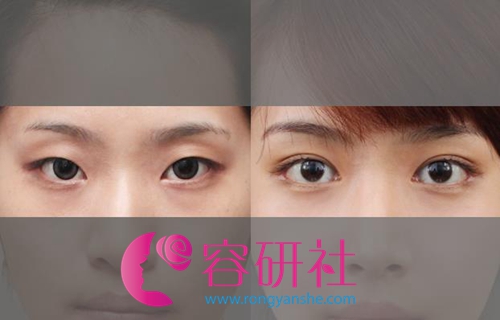 韩国原辰整形医院眼部手术案例