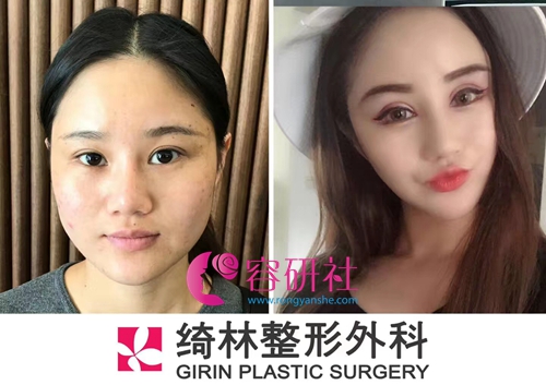 韩国绮林整形外科面部轮廓手术案例