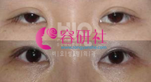 韩国bio整形医院眼部手术案例
