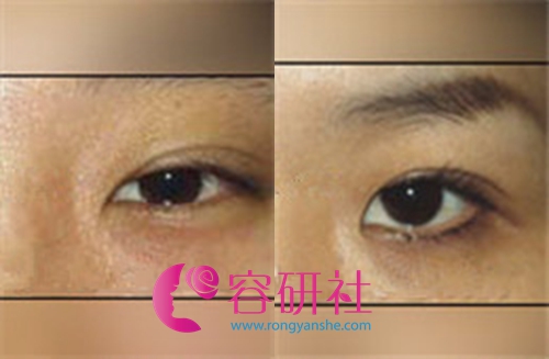 韩国枓翰整形个医院双眼皮手术案例