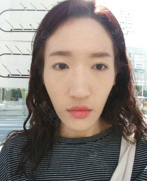 韩国eu整形外科长脸双鄂手术真人案例公开,术后效果超