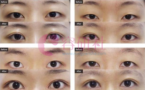 韩国ST整形医院双眼皮手术案例