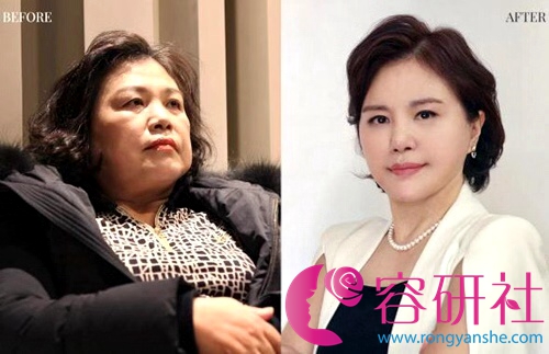 韩国医院面部提升抗衰老手术案例