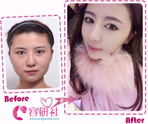韩国女神整形外科25°颧骨内推手术案例