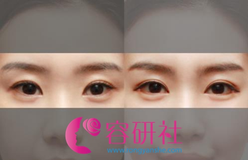 韩国原辰整形外科眼底脂肪再排列手术案例