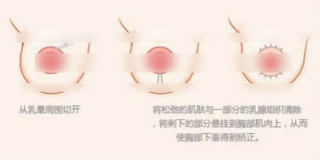 乳房下垂手术示意图 乳房下垂手术示意图