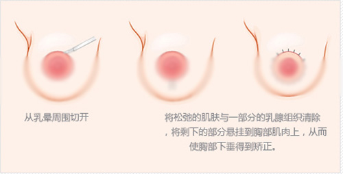 中度乳房下垂矫正手术效果 中度乳房下垂矫正手术效果