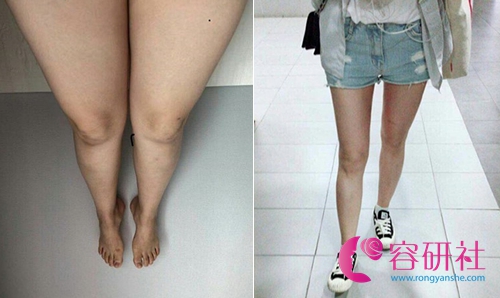 韩国美线整形大腿吸脂案例