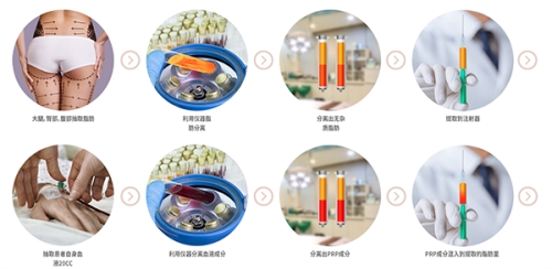 自体脂肪填充过程示意图 自体脂肪填充过程示意图