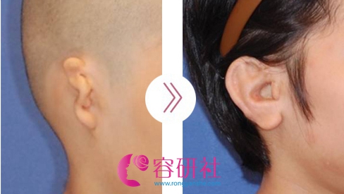 韩国普露菲耳profile整形医院小耳症矫正案例
