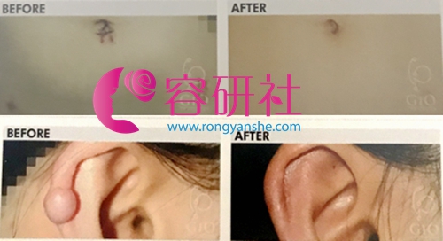 韩国gio医院肚脐疤痕和耳朵疤痕修复案例