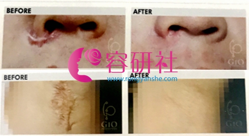 韩国gio医院隆鼻术后和大面积疤痕修复案例