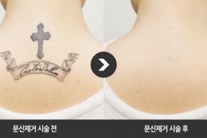 韩国激光清洗纹身