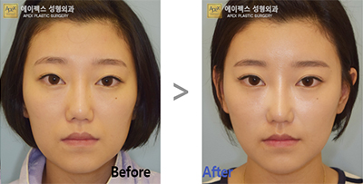 韩国apex整形外科脂肪填充案例