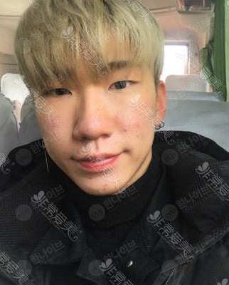 痘肌治疗三个疗程后效果 痘肌治疗三个疗程后效果