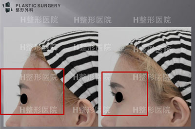 韩国H白桓汀整形外科眉弓案例