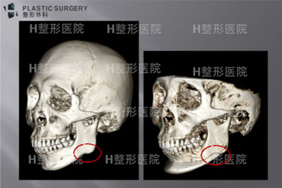 韩国H整形外科下颌角修复案例
