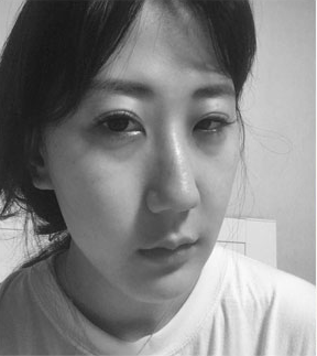 韩国dreamline整形外科大小眼矫正手术案例 韩国dreamline整形外科大小眼矫正手术案例