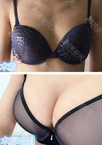 MIGO假體隆胸手術圖片 MIGO假體隆胸手術圖片