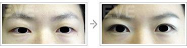 韩国eve整形外科双眼皮手术日记对比图