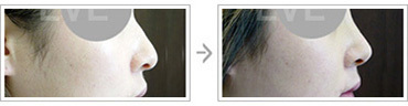 韩国eve整形外科隆鼻手术案例对比图