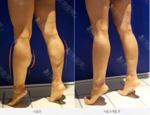 怎样快速瘦腿小妙招 怎样快速瘦腿小妙招