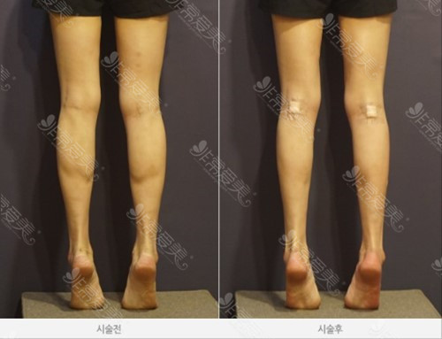 如何快速瘦小腿方法 如何快速瘦小腿方法
