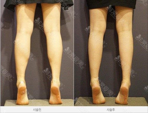 怎么有效瘦小腿 怎么有效瘦小腿