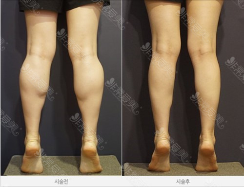 肌肉型小腿怎么变瘦 肌肉型小腿怎么变瘦