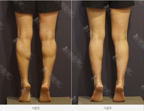 怎么样才能让腿变瘦案例图 怎么样才能让腿变瘦案例图