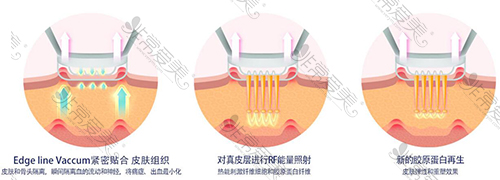 韩国菲斯莱茵微笑提升优势图 韩国菲斯莱茵微笑提升优势图