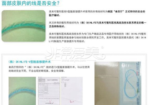 埋线提升好不好 埋线提升好不好