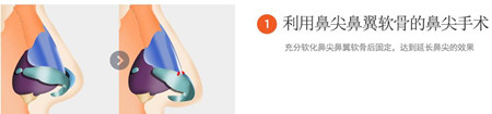 4月31日醫院用鼻翼軟骨塑造鼻尖 4月31日醫院用鼻翼軟骨塑造鼻尖