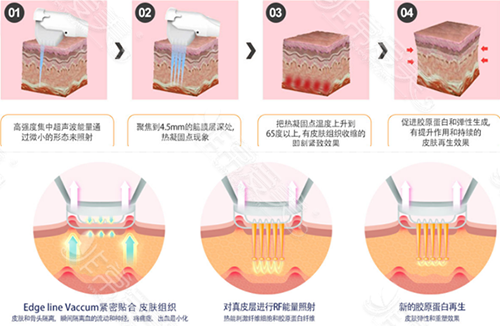 弹力激光、Smile提升示意图 弹力激光、Smile提升示意图