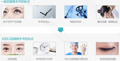 无切口开外眼角手术优势 无切口开外眼角手术优势