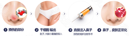 挛缩鼻能修复几次 挛缩鼻能修复几次