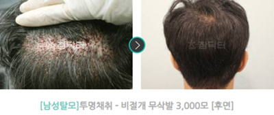 韩国真满植发医院无痕植发图