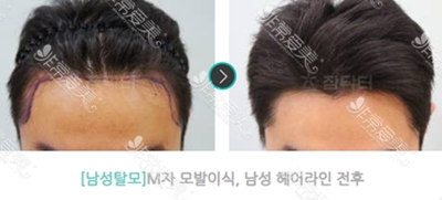 韩国真满毛发移植案例对比
