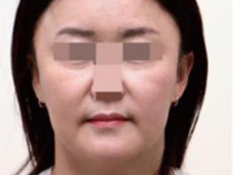 面部脂肪型鼻唇沟参照图 面部脂肪型鼻唇沟参照图